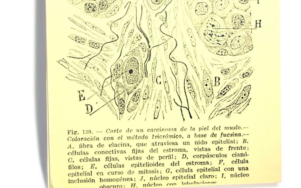 Lámina: Corte de un carcinoma