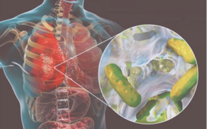 Un acercamiento a la Fibrosis Quística
