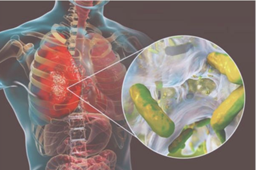 Un acercamiento a la Fibrosis Quística Un acercamiento a la Fibrosis Quística
